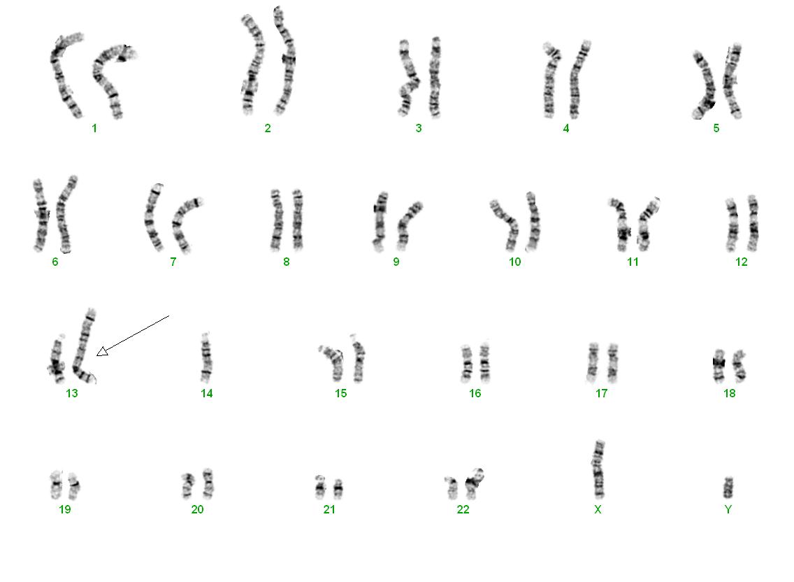 Robertson Translokation (13;14) Karotyp: 45,XY,rob(13;14)(q10;q10)