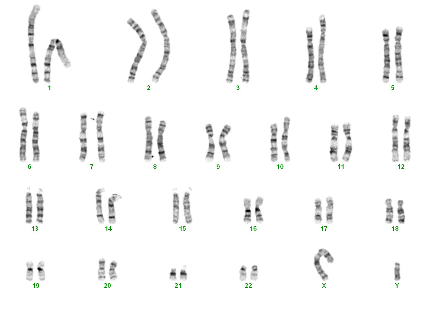 Karyogramm männlich (Karyotyp: 46,XY)