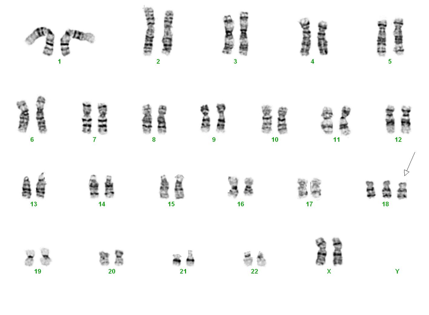 Karyogramm: Trisomie 18 (Karyotyp: 47,XX,+18)