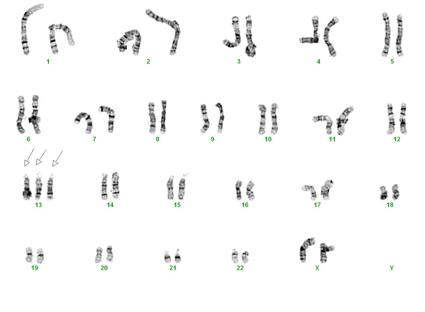 Karyogramm: Trisomie 13 (Karyotyp: 47,XX,+13)