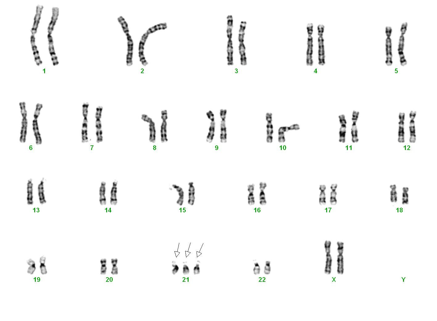 Karyogramm: Trisomie 21 (Karyotyp: 47,XX,+21)